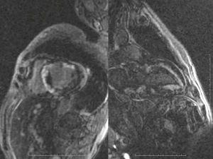 The patchy involvement seen in this patient can also be seen in amyloidosis. The decreased signal in the ventricular cavity provides a clue.