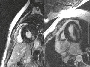 A patient initially thought to have amyloidosis is found to have no subendocardial LGE. The signal is also present in the cavity. This patient has mid-lateral wall involvement and was later diagnosed with Fabry's disease.