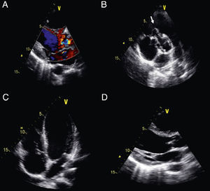 Transthoracic echocardiography. (A) Parasternal long-axis view with color Doppler disclosing a left-to-right shunt through a ventricular septal defect (VSD). (B) Parasternal short-axis view showing lack of support of the aortic valve, leading to a diagnosis of perimembranous VSD, vegetation attached to the atrial side of the tricuspid valve, and aneurysmatic image of the tricuspid valve, difficult to distinguish from a vegetation attached to the membranous portion of the VSD. (C) Apical 4-chamber view confirming the presence of the vegetation attached to the atrial side of the tricuspid valve. (D) Parasternal long-axis view displaying the vegetations attached to the right and non-coronary aortic cusps.