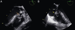 Transesophageal echocardiography (TEE). (A) TEE at 131° disclosing a vegetation attached to the VSD protruding into the right ventricle (orange arrow) with prolapse of the right aortic cusp and the vegetation attached to the VSD. (B) TEE at 0° shows the aneurysm of the septal leaflet of the tricuspid valve (white arrow) and the vegetation on the atrial side (yellow arrow).