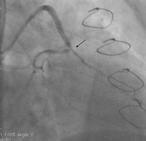 Angiogram showing stent placement (arrow).