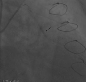 Angiogram showing stent deployment (arrow).