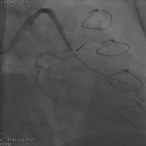 Angiogram immediately after post-dilatation of the stent (arrow).