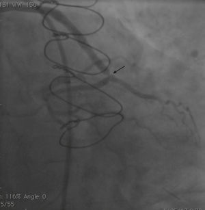 Angiogram showing significant stent recoil (arrow).