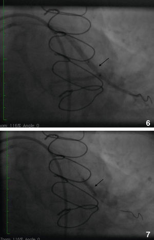 Angiograms showing positioning of the cutting balloon and stent dilatation (arrows).