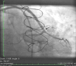 Angiogram showing expanded stent after cutting balloon angioplasty (arrow).