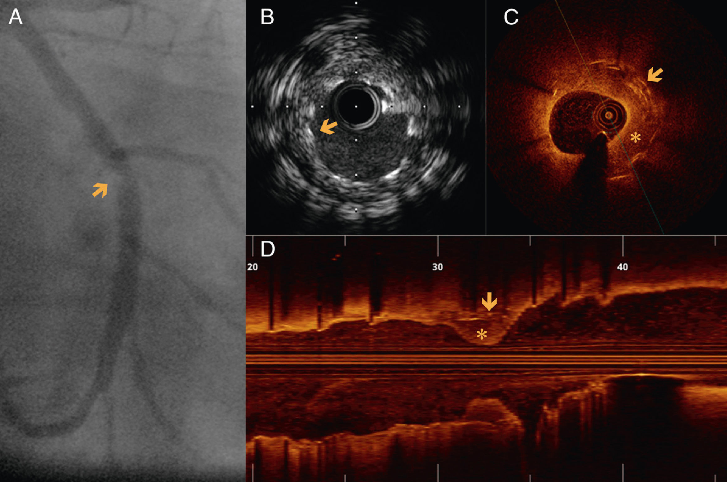 Utility of optical coherence tomography and intravascular ultrasound ...