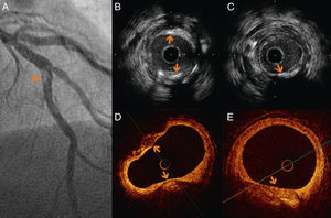 (A) Coronary angiography of the LAD in right anterior oblique cranial view, showing a focal lesion, spiculated, with irregular edges, consistent with highly calcified atheroma (arrow). (B and C) IVUS images of the calcified lesion in the LAD. (B) Two calcified lesions characterized by significant birefringence, with acoustic back-scattering (arrows). (D and E) OCT shows a lesion with clear borders and regions of late enhancement and low signal, identifying a large calcified lesion (arrows).
