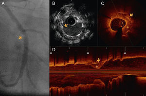 (A) Angiography of the left circumflex artery in right anterior oblique caudal view, showing a focal in-stent lesion with defined edges, difficult to interpret (arrow). (B) IVUS in a region where there are two overlapping stents, with correct apposition, without apparent neointimal proliferation (arrow) and no visible injury to explain the angiographic findings. (C and D) OCT images, in C showing the stent zone overlap (arrow), with significant restenosis (asterisk). Longitudinal OCT reconstruction (D) shows focal restenosis (asterisk) on the overlapping struts (arrows).