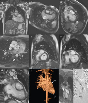 Balanced steady-state free precession (b-SSFP) cine images depicting normal situs (A) and atrioventricular (AV) and ventriculoarterial discordance (B and C, respectively). Note the aorta arising anteriorly and to the right of the pulmonary artery (D). An important clue to the diagnosis of criss-cross heart is the inability to image flow across the two AV valves in the same plane. b-SSFP cine images show this unusual arrangement of the AV valves, perpendicular to one another (E), with the subpulmonary left ventricle (LV) located inferiorly and the smaller systemic right ventricle (RV) superiorly, resulting in a twisted appearance (G); a large (approximately 20 mm) non-restrictive ventricular septal defect is also noted, with bidirectional flow (F). Contrast-enhanced 3D magnetic resonance angiography was performed to help delineate the anatomical relations described above and to assess the great vessels and their branches (H). Phase-contrast velocity mapping of pulmonary stenosis, located at both sub-valvular (from an indented ridge) and valvular level, a common feature of this congenital cardiac anomaly (I). Ao: aorta; LV: left ventricle; PA: pulmonary artery; PAVV: pulmonary AV valve; PV: pulmonary valve; RA: right atrium; RV: right ventricle; SAVV: systemic AV valve; VSD: ventricular septal defect.