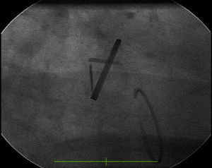 Fluoroscopic image showing incomplete mitral prosthetic valve closure.