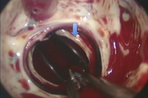 Intraoperative image showing pannus on the aortic prosthesis (arrow).