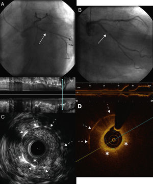 (A and B) Coronary angiography showing severe intrastent restenosis at the level of the proximal circumflex artery (solid arrows) with distal TIMI 3 flow; (C) intravascular ultrasound images of the restenosis showing heterogeneous tissue with hypoechogenic areas on the surface (asterisk) and correct expansion of the stent implanted in 2002, with no sign of fracture (dotted arrows); (D) optical coherence tomography images of the restenosis showing neointima with a lipid appearance surrounded by a hyperintense fibrous capsule and consisting of hypointense tissue with poorly defined borders and high attenuation (asterisks) producing a shadow that restricts visualization of the stent struts (dotted arrows).
