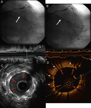 (A) Bare-metal stent-in-stent placement in the restenosis (solid arrow); (B) angiographic result of direct stent placement, with no significant residual stenosis (solid arrow); (C and D) intravascular ultrasound and optical coherence tomography images of the newly implanted stent, showing correct expansion and complete apposition of all struts (solid red arrows), together with struts of the stent implanted in 2002 (dotted arrows).
