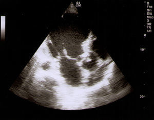 Aortic valve with two adherent nodular formations, causing poor coaptation and mild to moderate aortic regurgitation.