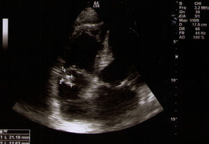 Tricuspid valve with mobile echogenic structure compatible with vegetation measuring over 13 mm.