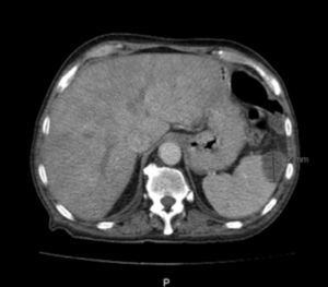 Abdominal computed tomography scan showing splenic infarction.