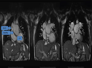The compressed baffle is better seen in this image where the pulmonary artery trunk is aneurysmatic. The image on the extreme right shows the inferior vena cava also returning to the subpulmonary left ventricle. LV: left ventricle; SVC: superior vena cava.