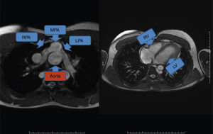 This patient has undergone the arterial switch operation and has normally configured ventricles. The Lecompte maneuver has been applied to the branches of the pulmonary artery, making them straddle the neoaorta. The pulmonary artery is in front of the aorta in an anteroposterior position, while normally the main pulmonary artery trunk is to the left of the aorta. LPA: left pulmonary artery; LV: left ventricle; MPA: main pulmonary artery; RPA: right pulmonary artery; RV: right ventricle.
