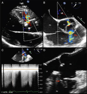 (A) Transthoracic color Doppler echocardiography, parasternal long axis view, showing a continuous flow from the aorta to the right ventricle (arrow). (B) Transesophageal color Doppler echocardiography, mid-esophageal plane at 51°, showing the jet of the fistula (arrow) and moderate eccentric aortic regurgitation. (C) Continuous wave Doppler showing systolic-diastolic flow at the fistula level (arrow). (D) Transesophageal echocardiography, mid-esophageal plane at 124° (zoomed in on the aorta), showing a tubular communication between the right sinus of Valsalva and the right ventricle (arrow). Ao: aorta; LA: left atrium; LV: left ventricle; RA: right atrium; RV: right ventricle.