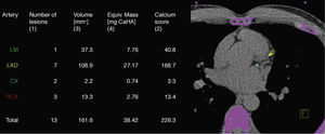 Calcium score in the epicardial coronary arteries. Cx: circumflex; LAD: left anterior descending; LM: left main; RCA: right coronary artery.