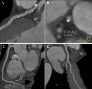 Cardiac CT: (A) predominantly calcified plaques throughout the left anterior descending; (B) eccentric mixed plaque with positive remodeling; (C and D) circumflex and dominant right coronary artery showing minor mixed plaques without significant stenosis.