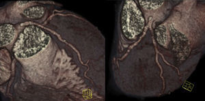 Volume-rendered reconstruction of the coronary tree showing atherosclerotic plaques throughout the left coronary artery, without causing significant stenosis.
