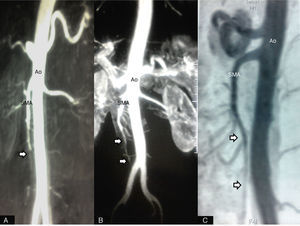 (A) A computed tomography (CT) scan within the first 24hours showed absence of contrast in the superior mesenteric artery (SMA) (arrow). Follow-up CT scans demonstrated gradual improvement in flow through the SMA (arrows) at 10 days (B) and two months (C). Ao: aorta; SMA: superior mesenteric artery.