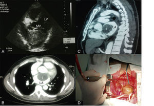 (A) A solid mass in the left atrium seen with transesophageal echocardiography, measuring 6.65 cm×4.22 cm (T). Axial (B) and sagittal (C) CT scans of the thorax showing a large filling defect in the left atrium (T). (D) Photograph of the resected mass (6.5 cm×4.5 cm). LA: left atrium; LV: left ventricle; MV: mitral valve; T: tumor.