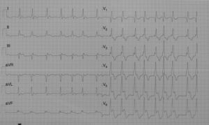 The ECG shows an unusual 4-mm convex ST segment elevation in C4–C6 with biphasic T waves.