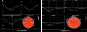 Longitudinal peak systolic strain curves from apical views and bull