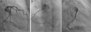 Coronary angiography: (A) (right anterior oblique 30°; caudal 20°) showing the left coronary artery with no epicardial lesions; (B) (left anterior oblique 20°; cranial 20°) and (C) (right anterior oblique 30°) showing the right coronary artery with no epicardial lesions, originating in the left anterolateral aortic wall, above the sinuses of Valsalva.