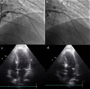 Change in the target vessel after contrast injection: (a) selective catheterization of the second septal branch; (b) selective catheterization of the first septal branch; (c) opacification of the right side of the septum after injection of contrast in the second septal branch; (d) opacification of the appropriate region of the septum (below the anterior leaflet of the mitral valve), following contrast injection in the first septal branch.