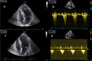 Echocardiographic images: (a) transthoracic echocardiography, 4‐chamber view, before the intervention; (b) continuous Doppler study showing subaortic gradient before the intervention; (c) transthoracic echocardiography, 4‐chamber view, three months after the intervention, showing decreased thickness of the basal septum; (d) continuous Doppler study three months after the intervention, showing reduction in the subaortic gradient.