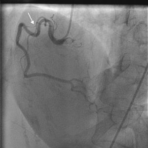 Coronary angiogram in left anterior oblique cranial view of the right coronary artery showing minimal coronary artery disease in the proximal part.