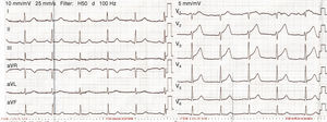 Electrocardiogram revealing 1–2 mm ST elevation in the anterior leads.