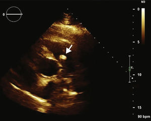 Parasternal short‐axis view, transthoracic echocardiography, demonstrating the mass (arrow) attached to the right leaflet of the pulmonary valve.