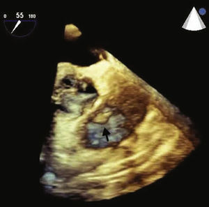 Three‐dimensional transesophageal echocardiogram (mid‐esophageal view) showing the tumor (arrow) on the pulmonary valve.