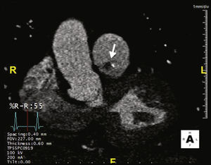 Coronal computed tomography angiography demonstrating a partially calcified mass (arrow) at the level of the pulmonary valve.