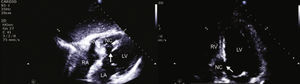Transthoracic echocardiography, subcostal (left) and apical 4‐chamber view, zoom on the left ventricle (right). Rupture of the interventricular septum, with septal dissection. LA: left atrium; LV: left ventricle; NC: neocavity formed by the dissection of the interventricular septum; RA: right atrium; RV: right ventricle. Arrow: interventricular septal rupture.