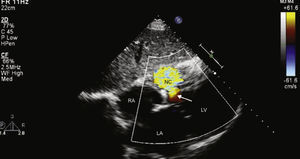 Transthoracic echocardiography, subcostal view. After surgery, an interventricular communication remains, with left‐to‐right shunt. LA: left atrium; LV: left ventricle; NC: neocavity formed by the dissection of the interventricular septum; RA: right atrium. Arrow: interventricular septal rupture.