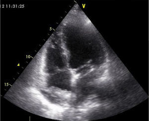 Initial assessment by transthoracic echocardiography (apical 4-chamber view), showing a heterogeneous echodense image (3cm×2.2cm) adhering to the right atrial roof, interpreted as a thrombus.