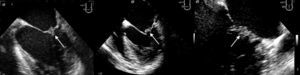 Transesophageal echocardiography on January 28, 2010, in intermediate long-axis 2-chamber view at 41°, showing a mass on the atrial face of the posterior mitral valve leaflet (arrows).