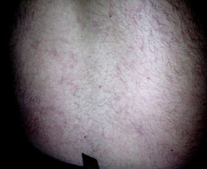 Photograph of the patient's back on May 24, 2010 showing purplish livedo reticularis.