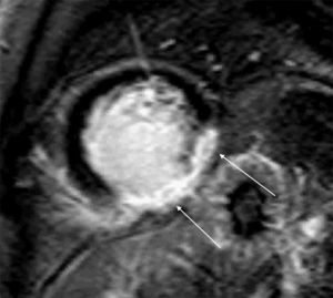 Cardiac magnetic resonance imaging on May 14, 2010: short-axis view with late gadolinium enhancement, showing transmural enhancement in the inferior and inferolateral walls of the left ventricle (arrows).