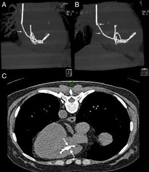Thoracic computed tomography. (A) and (B) Dense, elongated image extending from the right atrium to the right ventricle, ending in tangled loops within the ventricular chamber, and apparent fragmentation (arrows); (C) control exam after removal of the catheter, showing what appears to be an intracardiac fragment (arrows).