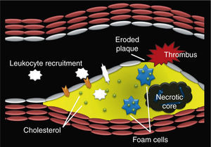 Schematic figure illustrating components of an eroded coronary atherosclerotic plaque with subocclusive thrombus. This type of vulnerable plaque is characterized by a thin fibrous cap, extensive leukocyte infiltration, paucity of smooth muscle cells and a large lipid core.