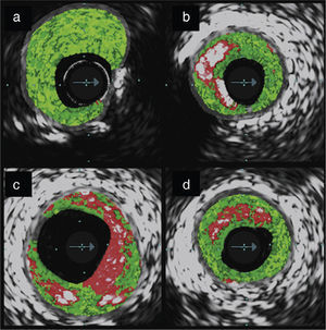 Types of atherosclerotic plaque characterized by intravascular ultrasound virtual histology: (a) fibrotic plaque; (b) fibrocalcific plaque; (c) thin‐cap fibroatheroma; (d) thick‐cap fibroatheroma.