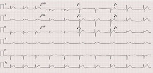 Twelve-lead electrocardiogram on admission to the emergency department.