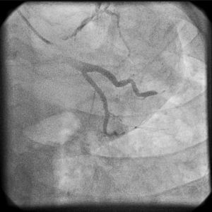 Coronary angiography showing a thrombus occluding the distal segment of the first obtuse marginal artery.